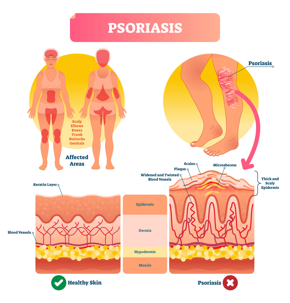 What is Scalp Psoriasis?