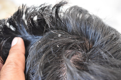 What is the difference between dry scalp and dandruff?